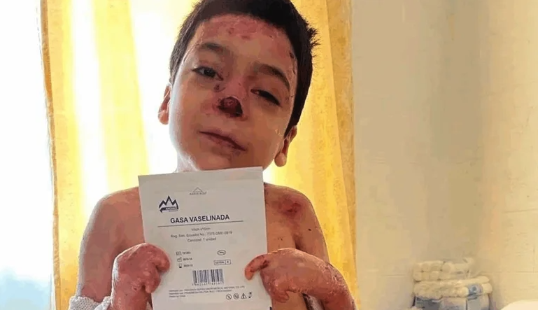 Ajude Guilherme no tratamento contra a Epidermólise Bolhosa